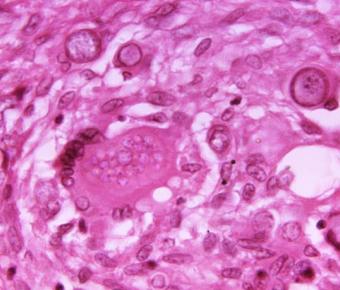 Coccidiomycosis photomicrograph magnified 500X. Photo: CDC 
